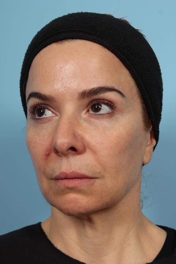 PDO Thread Lift — Before Treatment, Oblique View