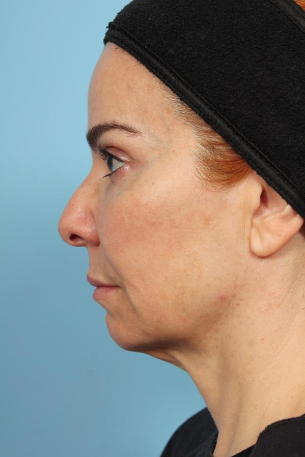 PDO Thread Lift — Before Treatment, Lateral View