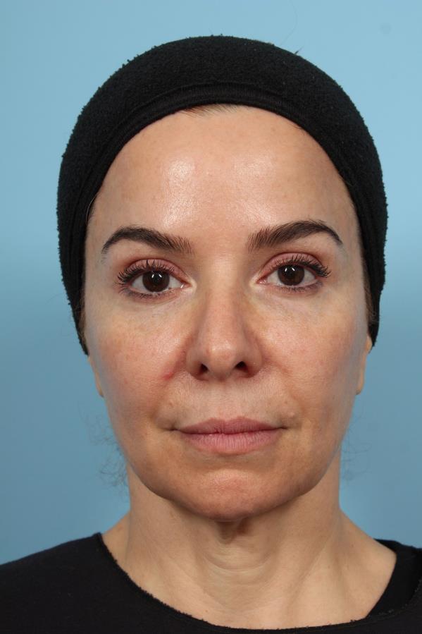 PDO Thread Lift — Before Treatment, Frontal View