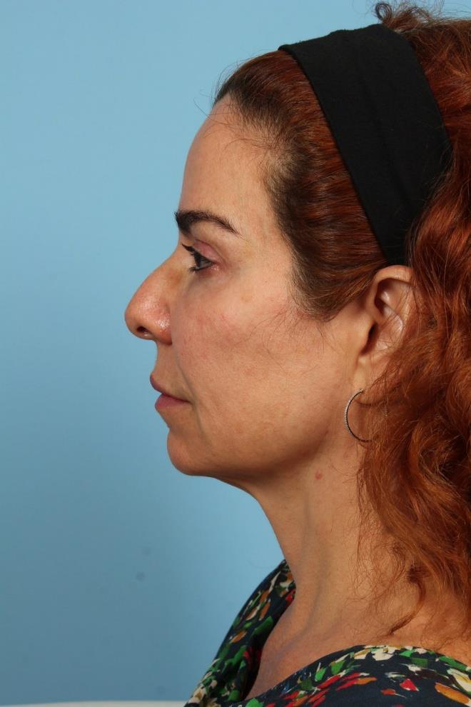 PDO Thread Lift — 16 Months Post-Treatment, Lateral View