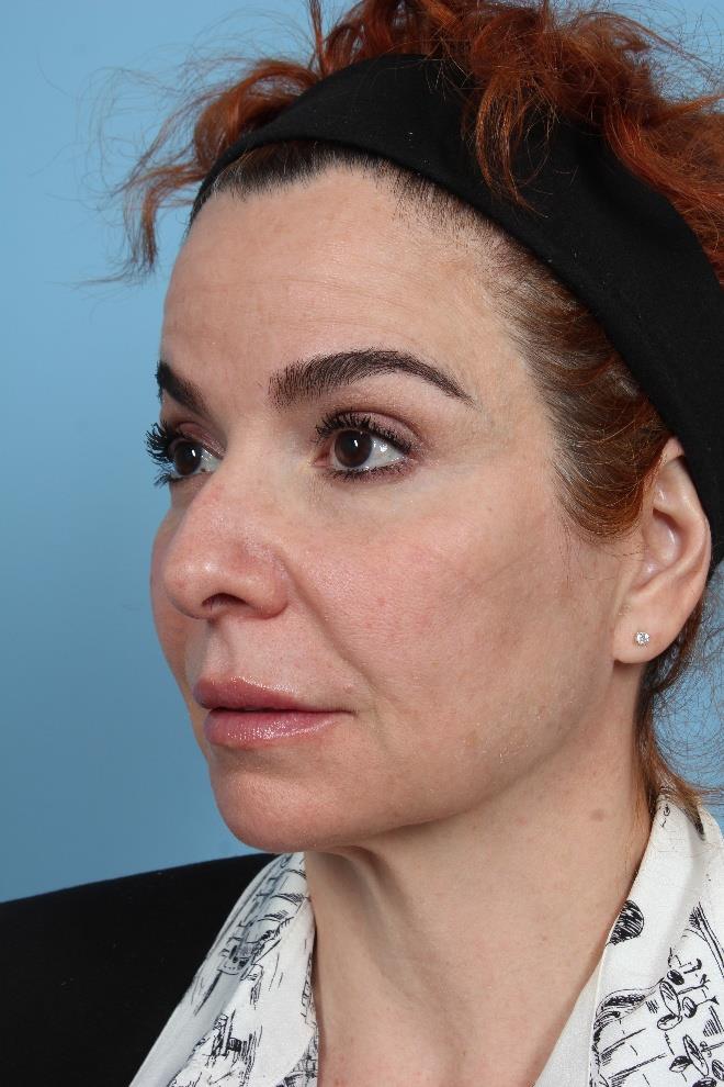 PDO Thread Lift — 2 Years Post-Treatment, Oblique View