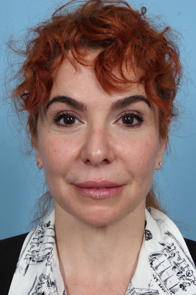 PDO Thread Lift — 2 Years Post-Treatment, Frontal View